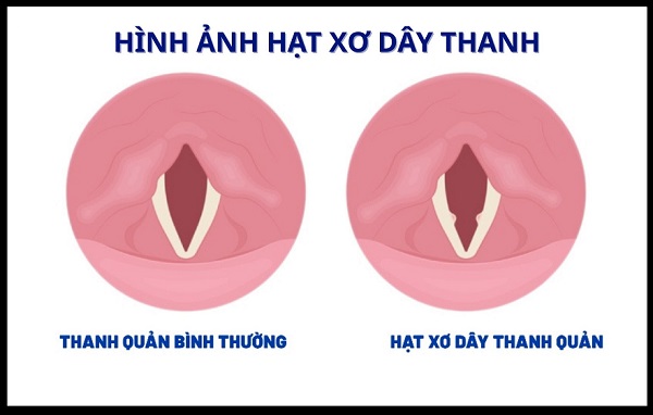 [GÓC GIẢI ĐÁP] Hạt xơ thanh quản có nguy hiểm không?