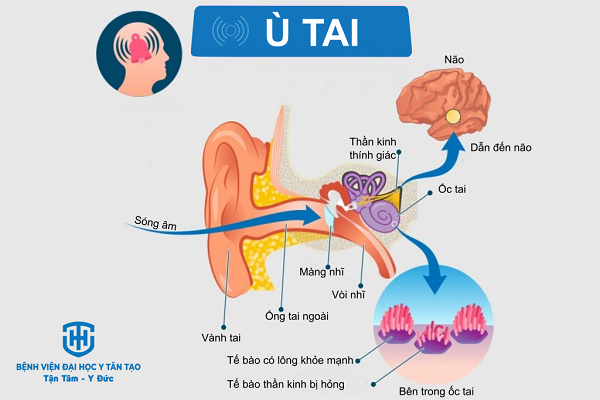 CẢNH BÁO: Ù tai kéo dài có thể là dấu hiệu sớm của điếc vĩnh viễn