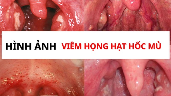 Viêm họng hạt hốc mủ – Làm sao để xử lý hiệu quả tình trạng bất thường này?