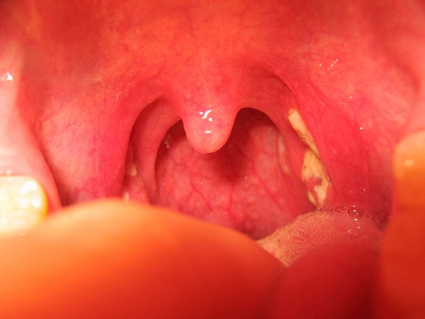 Viêm họng hạt hốc mủ – Làm sao để xử lý hiệu quả tình trạng bất thường này?