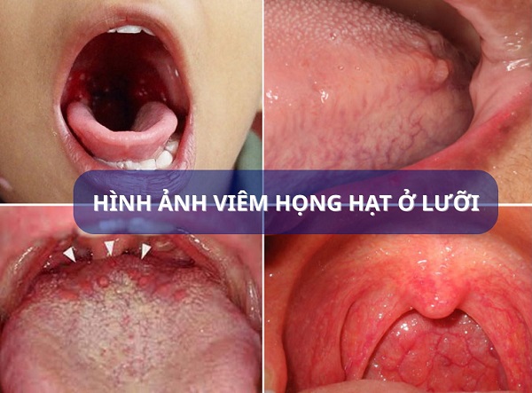 Viêm họng hạt ở lưỡi: Nhận biết kịp thời – Điều trị đúng cách – Hạn chế biến chứng
