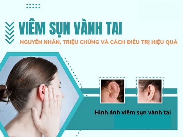 Viêm sụn vành tai có tự khỏi không? – Giải đáp cùng bác sĩ chuyên gia