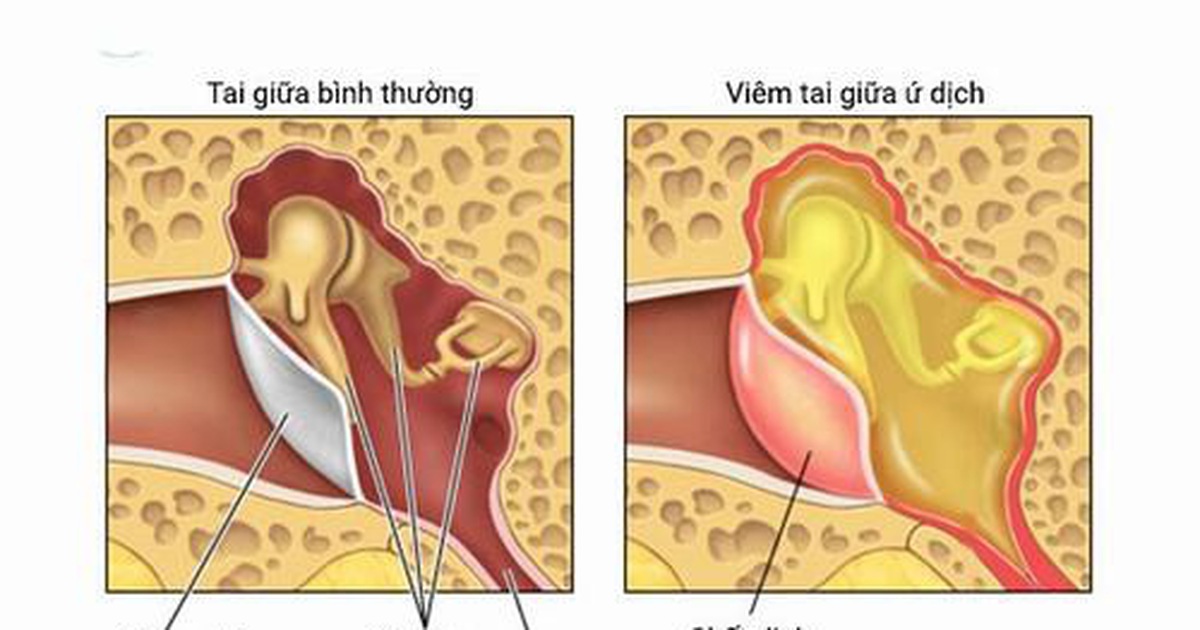 Nguy cơ mất thính lực vì chủ quan với tình trạng viêm tai giữa không mủ