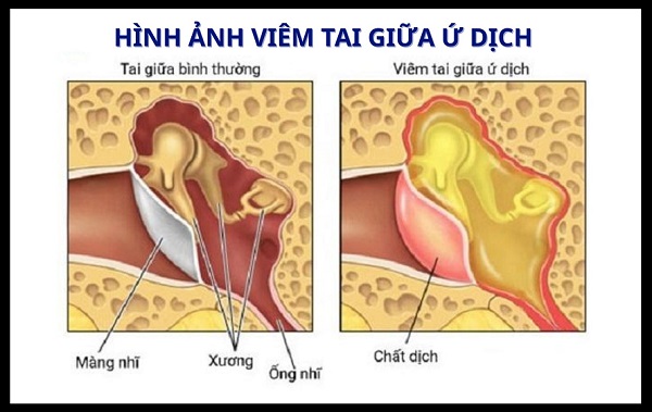 Viêm tai giữa ứ dịch 2 bên: Nguyên nhân, triệu chứng và cách điều trị hiệu quả