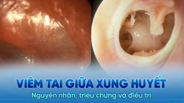Bị viêm tai giữa xung huyết điều trị ra sao? – Đọc bài viết sau để biết câu trả lời!