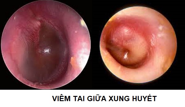Bị viêm tai giữa xung huyết điều trị ra sao? – Đọc bài viết sau để biết câu trả lời!