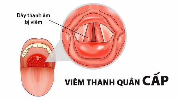 Tất tần tật những thông tin quan trọng bạn cần biết về viêm thanh quản!