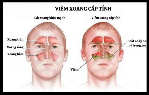 Bác sĩ chuyên khoa chỉ ra những dấu hiệu nhận biết viêm xoang cấp điển hình
