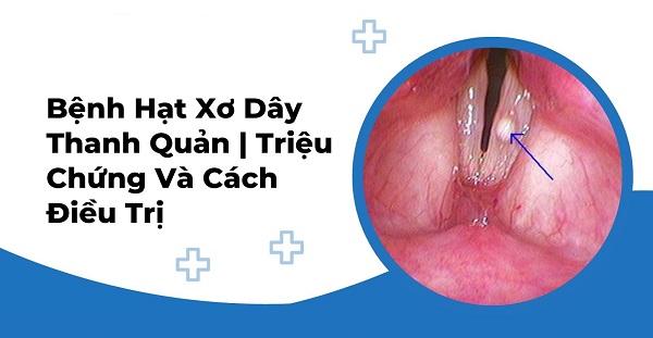 Bác sĩ giải đáp: Hạt xơ dây thanh là gì?